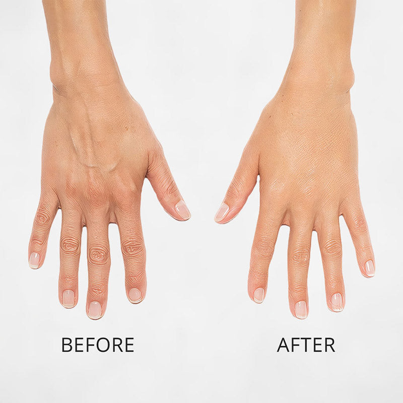 Radiesse for the Hands